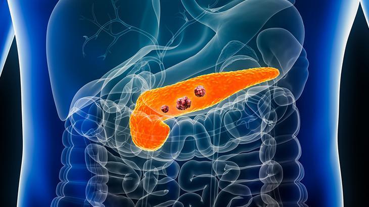 Pankreas kanserinde umutları artıran gelişmeler: ‘Sağ kalım oranı yüzde 54’e yükseldi’