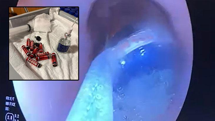 Cezaevindeki mahkumun midesinden çıkanlar şoke etti: 9 pil, 3 jilet