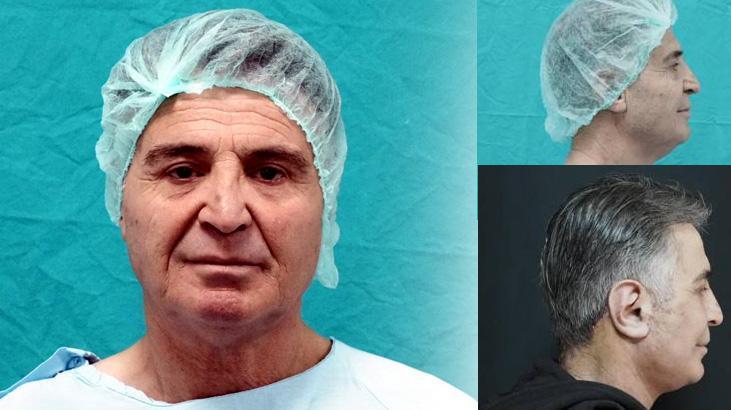 Devlet hastanesinde bir ilk! Ameliyat masasından 15 yıl gençleşerek kalktı