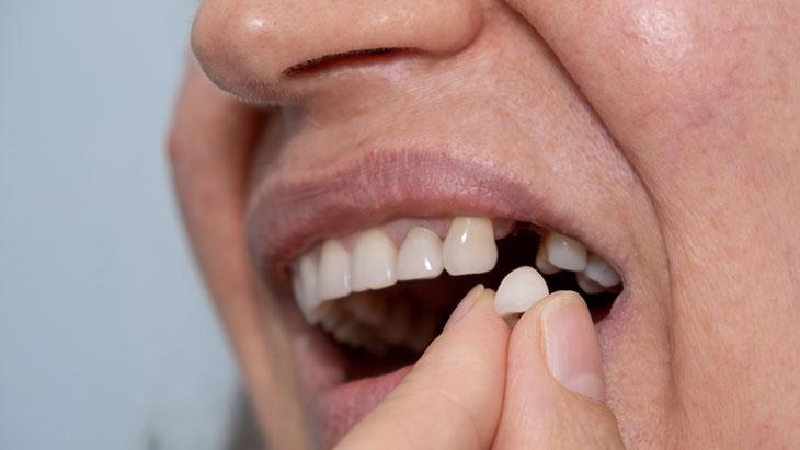 Diş kaybı yalnızca estetik bir sorun değilmiş! Etkisi bambaşka