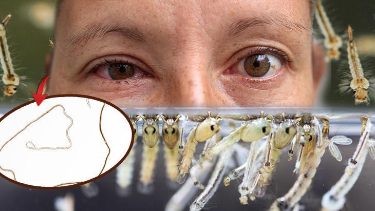 Gözüne inen solucanla aylarca yaşadı: ‘Çok nadir ama Türkiye de risk kuşağında’