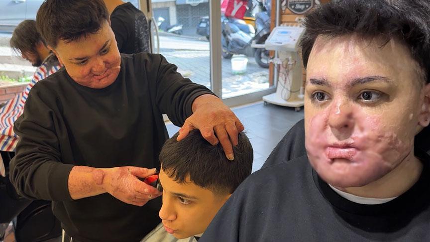 Hayatı birkaç saniye içinde kabusa döndü!15 yaşında 8 ayda 65 ameliyat geçirdi: ‘Babamdan özür diledim’