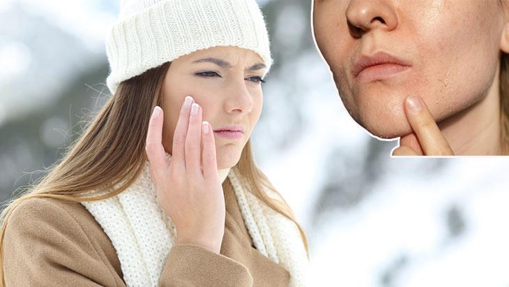 Soğuk hava cildi kurutup, sorunlara yol açıyor! 10 adımda önlemek mümkün