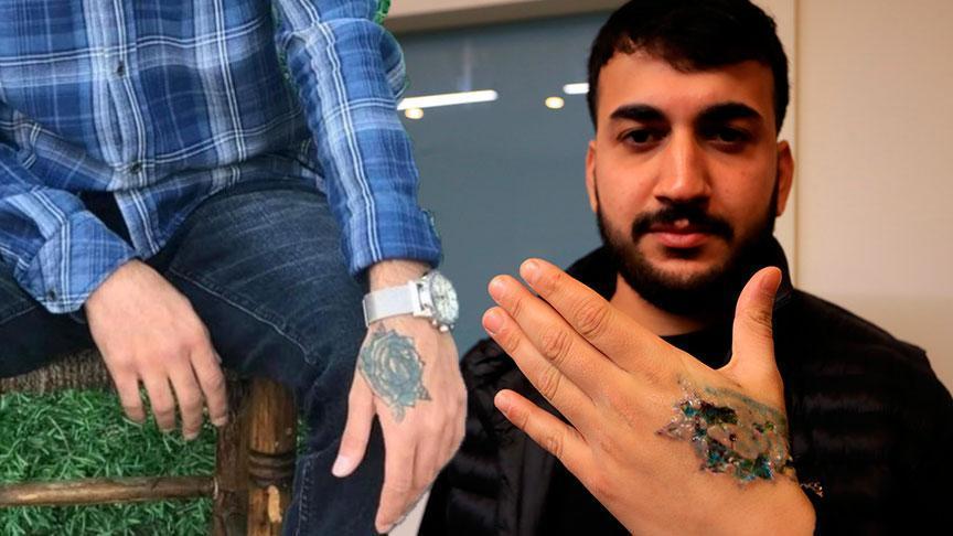 Dövme sildirmek isterken felaketi yaşadı! ‘Eczaneden ağrı kesici al’