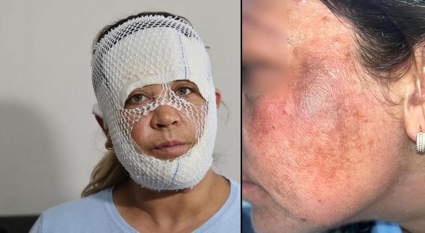 7 bin liralık ‘Prenses cilt bakımı’ kabusu: Oğlum beni görünce ‘öcü’ diyerek kaçtı