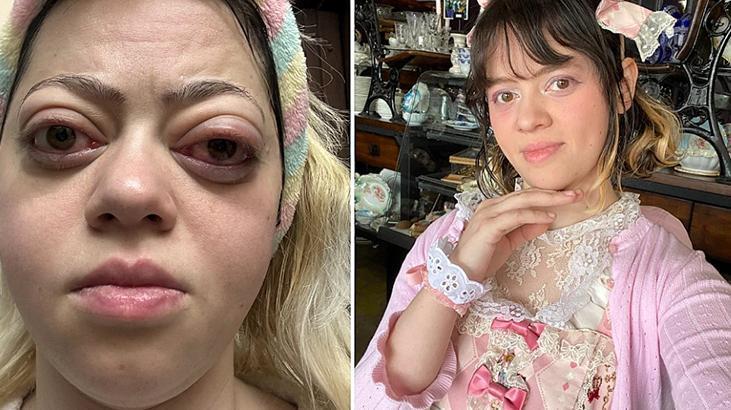 Gözleri birden bire kocaman oldu! Sebebi troid bezinde saklıymış