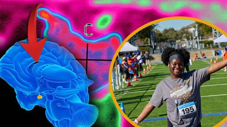 Koşarken başı ağrıdı, günlerce odadan çıkmadı! Beynindeki tümör kanser değilmiş: Hayatını değiştiren teşhis!