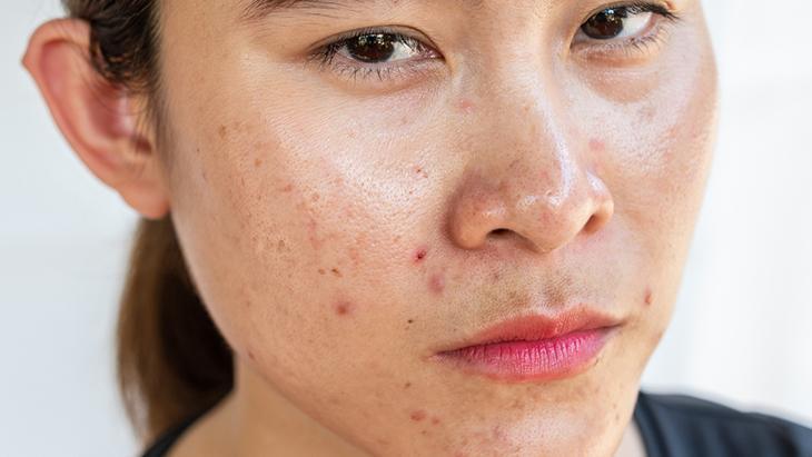 Pürüzsüz bir cilt için hormonal denge! Uzmanından tavsiyeler